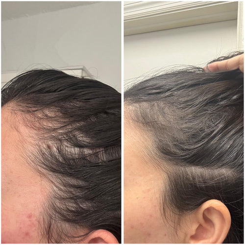 FOLLIQ Hair Regrowth System