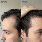 FOLLIQ - Hair Regrowth System