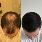 FOLLIQ - Hair Regrowth System