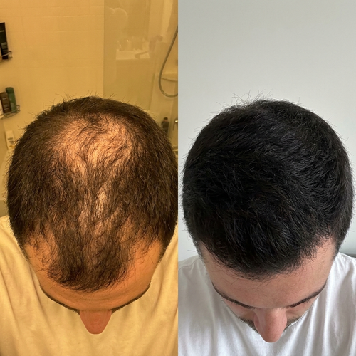 FOLLIQ - Hair Regrowth System